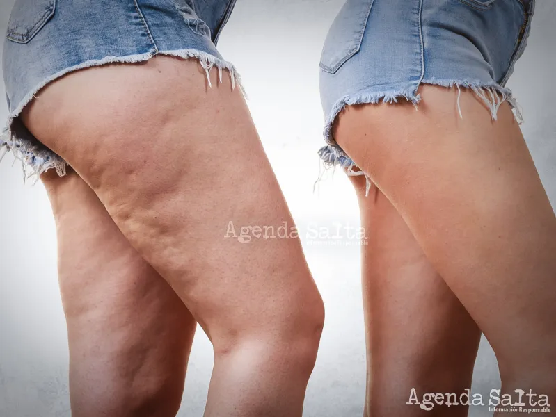 Celulitis clearance y shorts