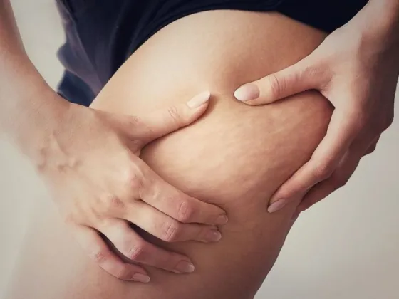 Los mejores alimentos para combatir la celulitis