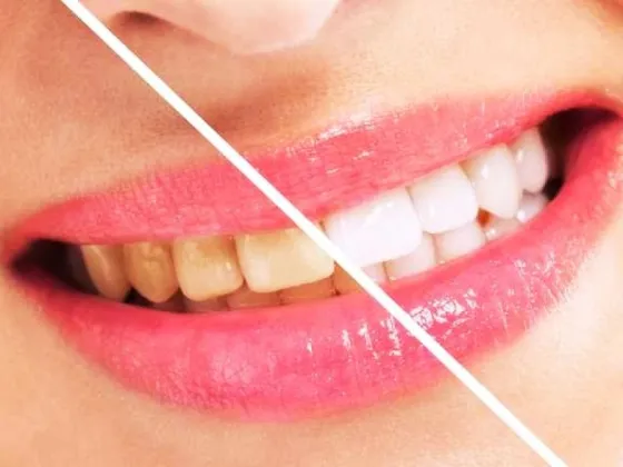 Dientes amarillos: el ingrediente casero que ayuda a blanquearlos y a disminuir las manchas