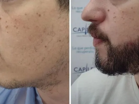 El boom de los trasplantes de barba: cómo es y cuánto cuesta el look de moda