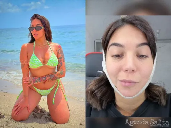 La influencer Luciana Milessi habló de la parálisis facial que sufre tras una liposucción de papada