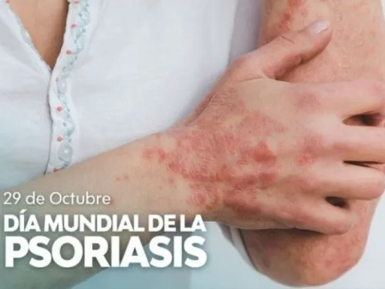 La psoriasis es una patología aún sin cura pero manejable con tratamiento