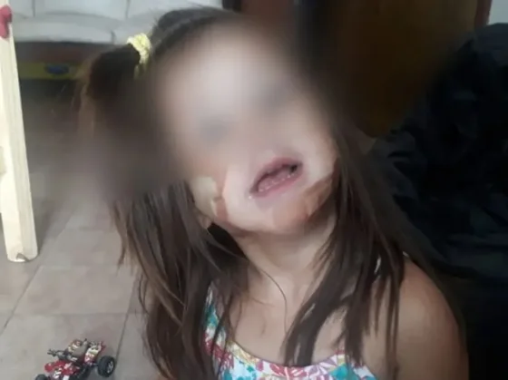 HORROR: una salteñita fue mordida por un pitbull y está grave