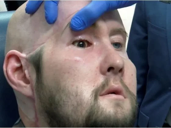 Avance médico: realizan en Estados Unidos el primer trasplante de un ojo entero