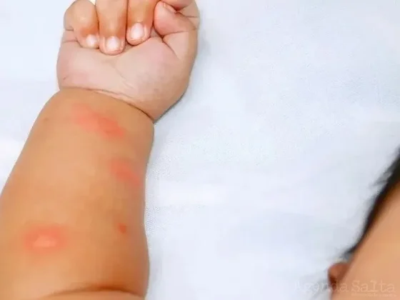 Dengue infantil: cómo son los síntomas y el tratamiento