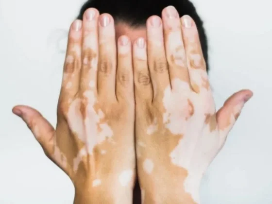 El vitiligo es una enfermedad crónica que no se contagia ni se hereda
