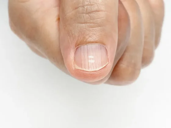 ¿Qué significa tener las uñas con rayas?
