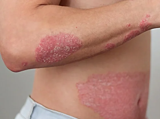 El Hospital San Bernardo realizará una campaña de detección de Psoriasis
