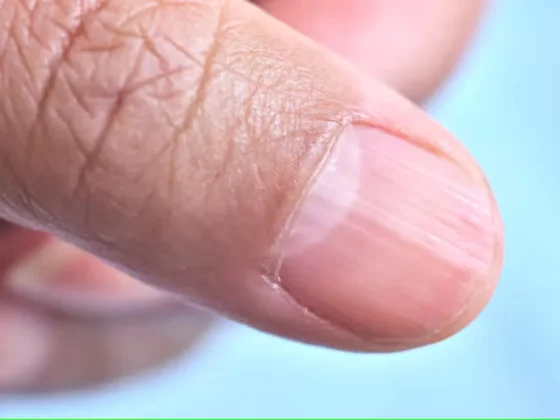 ¿Qué significa tener las uñas de las manos con rayas?