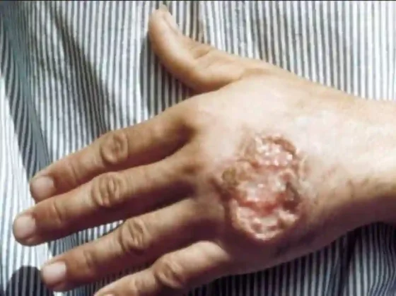 Leishmaniasis: crece la preocupación por nuevos casos en Salta