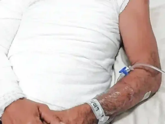 Pelea insólita: hermanos pelearon por un sachet de mayonesa y uno resultó con el cuerpo quemado