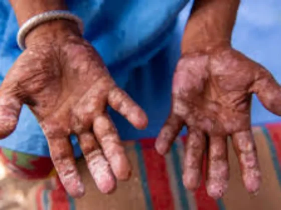 Se diagnosticaron seis casos de lepra en la provincia en el año 2024