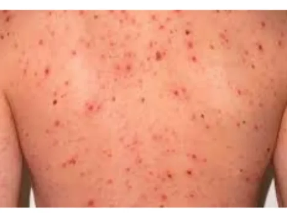 Recomendaciones ante la alerta epidemiológica por sarampión en el país