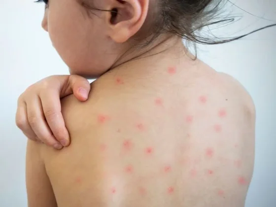 Estas son las recomendaciones ante la alerta epidemiológica por sarampión en el país