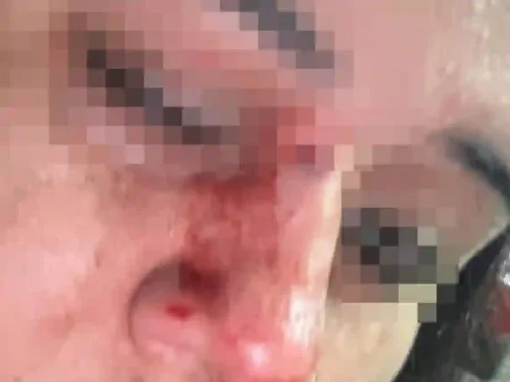 Salteña fue a una fiesta y terminó en el hospital con la cara destrozada