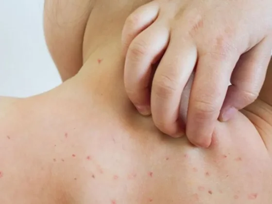 Alerta en Salta por tránsito de viajeros con sarampión desde Bolivia