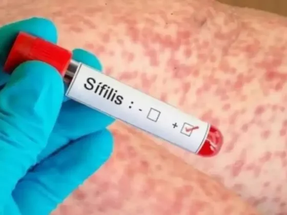 Preocupa el aumento de sífilis en Salta y advierten por la falta de cuidados en jóvenes